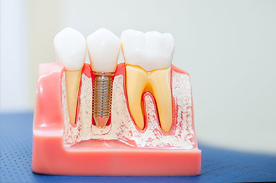 Terry Soule, DDS | Dental Bridges, Emergency Treatment and Preventative Program