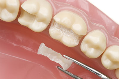 Terry Soule, DDS | Ceramic Crowns, Night Guards and Extractions