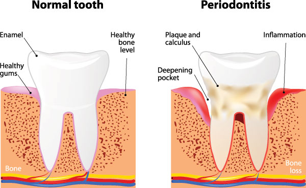 Terry Soule, DDS | Dental Fillings, Sports Mouthguards and Periodontal Treatment