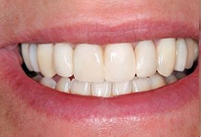 Terry Soule, DDS | Implant Dentistry, Veneers and Dental Fillings