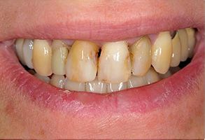 Terry Soule, DDS | Cosmetic Dentistry, Extractions and Veneers